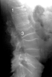 Multiple lumbar vertebrae fracture