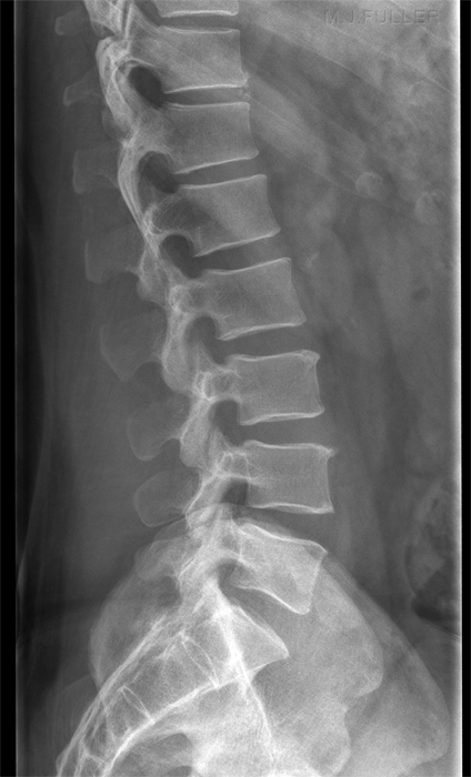 normal lumbar spine