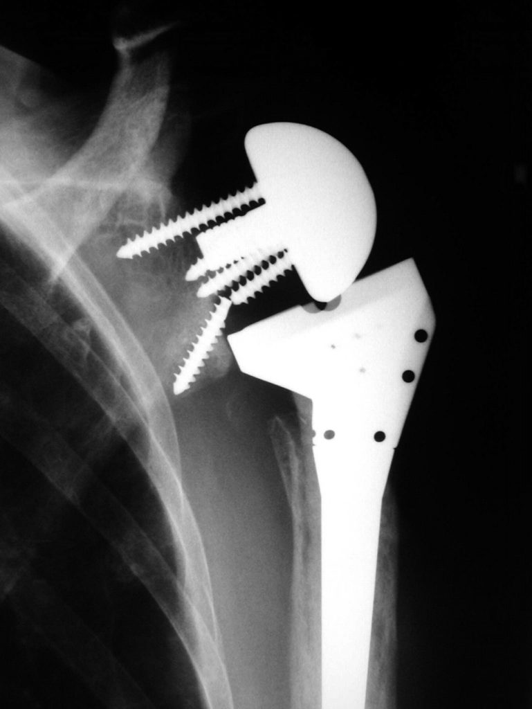 shoulder arthroplasty complication