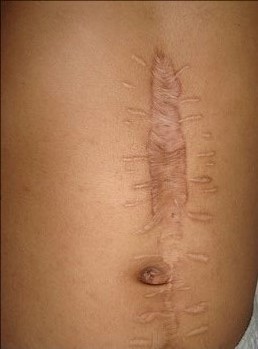 ugly abdominal scar