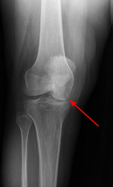 knee x-ray 6