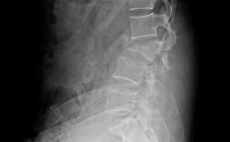 L3 fracture xray