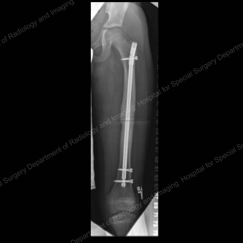 rigid-intramedullary-nail-femur-fracture